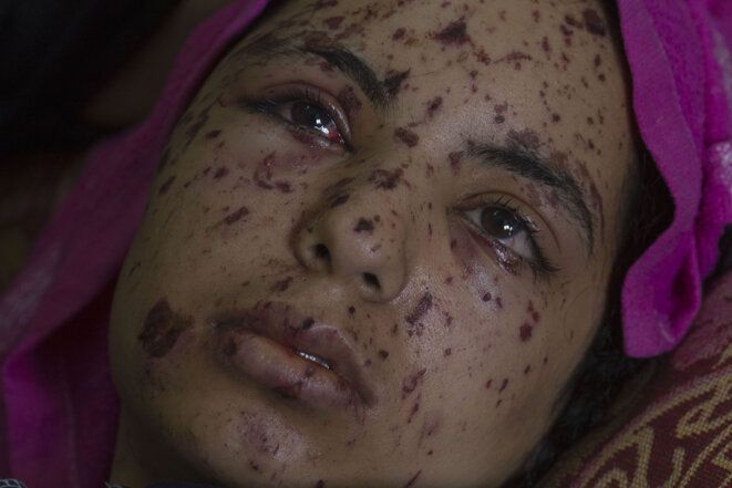 Gaza City, 22 juillet 2014 – Rawya abu Jon’an, 17 ans, à l’hôpital Shifa. Rawya a été blessée lorsque l’armée de l’air israélien © Heidi Levine / Sipa press Gaza City, 22 juillet 2014 – Rawya abu Jon’an, 17 ans, à l’hôpital Shifa. Rawya a été blessée lorsque l’armée de l’air israélien © Heidi Levine / Sipa press